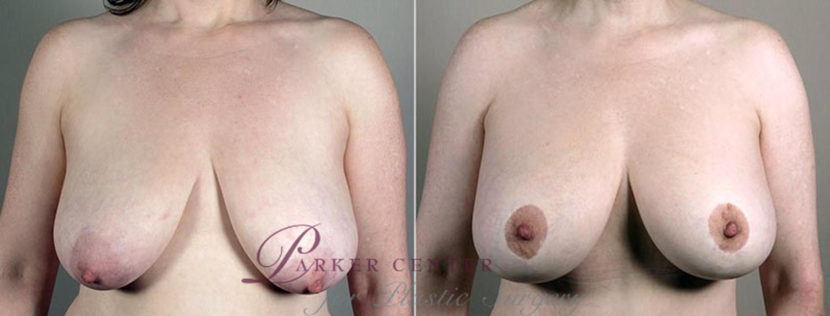 Breast Lift with Implants Case 466 Before & After View #1 | Paramus, NJ | Parker Center for Plastic Surgery