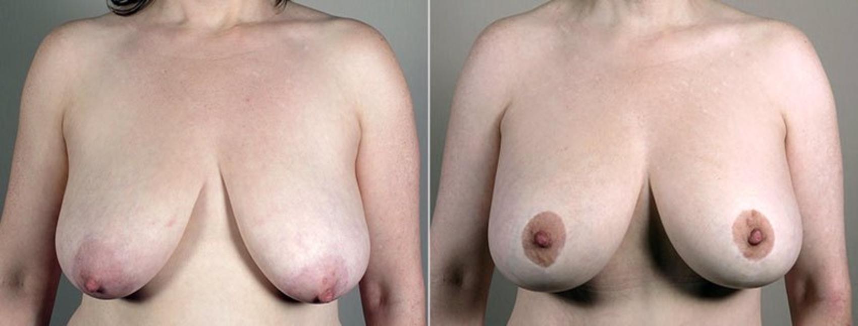 Breast Lift with Implants Case 466 Before & After View #1 | Paramus, NJ | Parker Center for Plastic Surgery