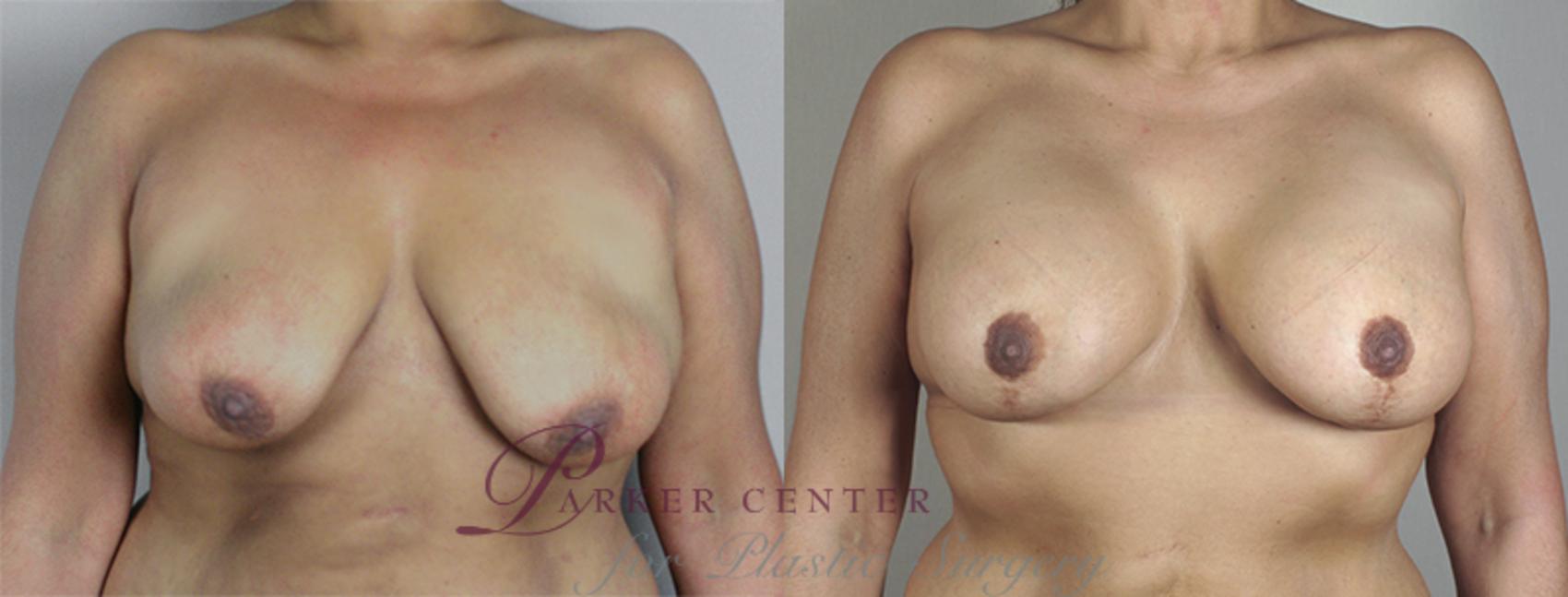 Breast Lift with Implants Case 468 Before & After View #1 | Paramus, NJ | Parker Center for Plastic Surgery