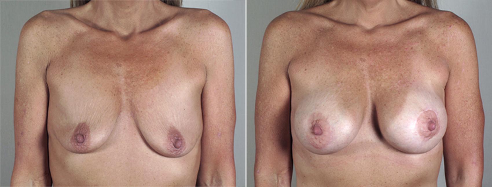 Breast Lift with Implants Case 469 Before & After View #1 | Paramus, NJ | Parker Center for Plastic Surgery