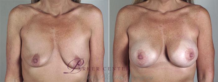 Breast Lift with Implants Case 469 Before & After View #1 | Paramus, NJ | Parker Center for Plastic Surgery
