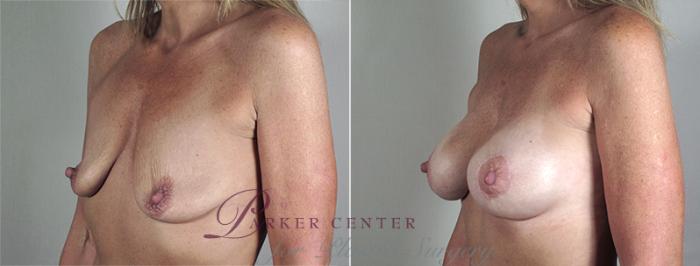 Breast Lift with Implants Case 469 Before & After View #2 | Paramus, NJ | Parker Center for Plastic Surgery