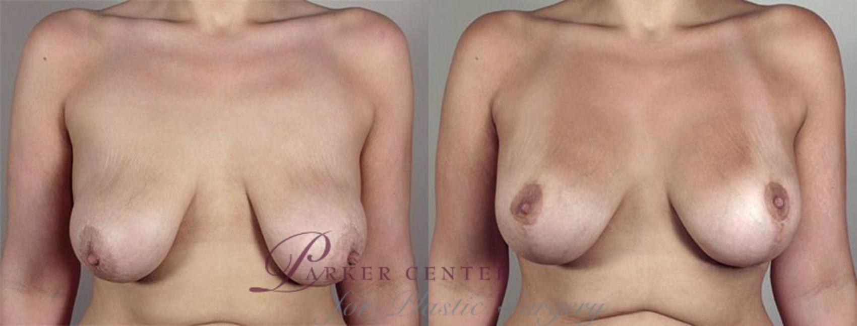 Breast Lift with Implants Case 470 Before & After View #1 | Paramus, NJ | Parker Center for Plastic Surgery