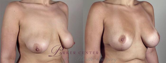 Breast Lift with Implants Case 470 Before & After View #2 | Paramus, NJ | Parker Center for Plastic Surgery