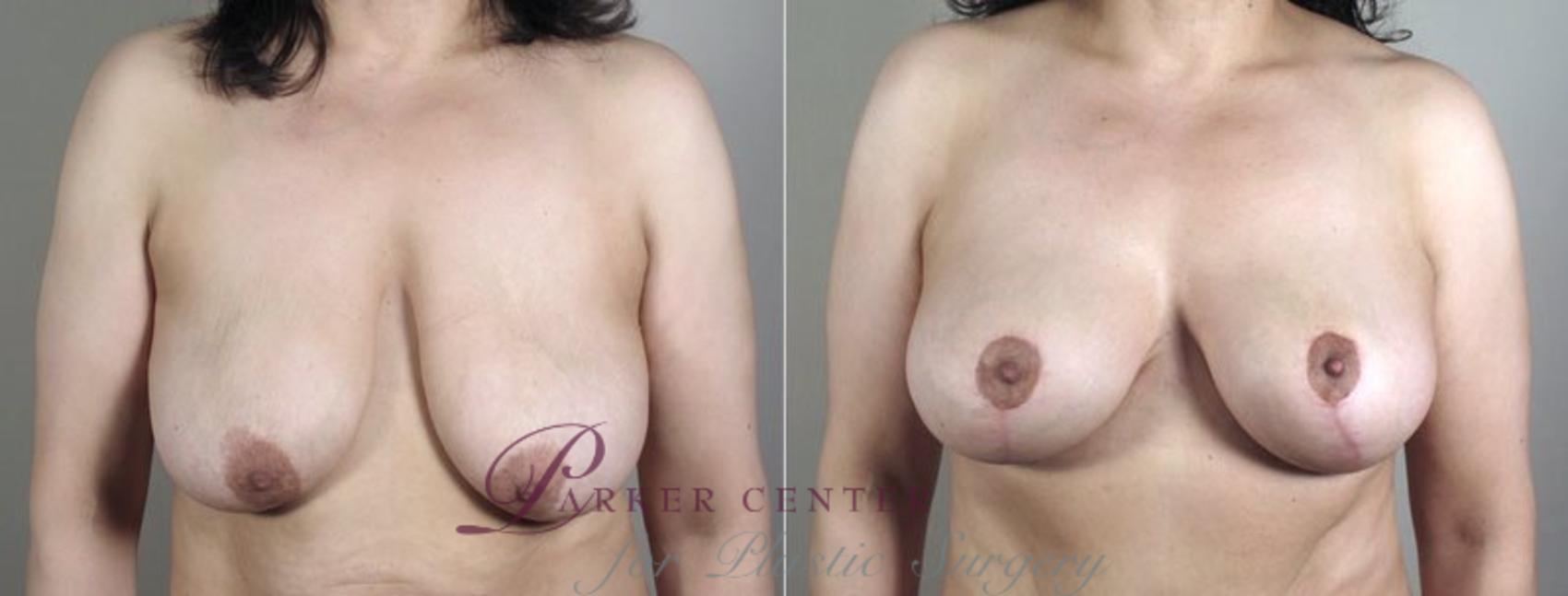 Breast Lift with Implants Case 472 Before & After View #1 | Paramus, NJ | Parker Center for Plastic Surgery