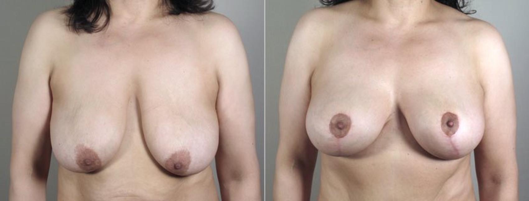 Breast Lift with Implants Case 472 Before & After View #1 | Paramus, NJ | Parker Center for Plastic Surgery