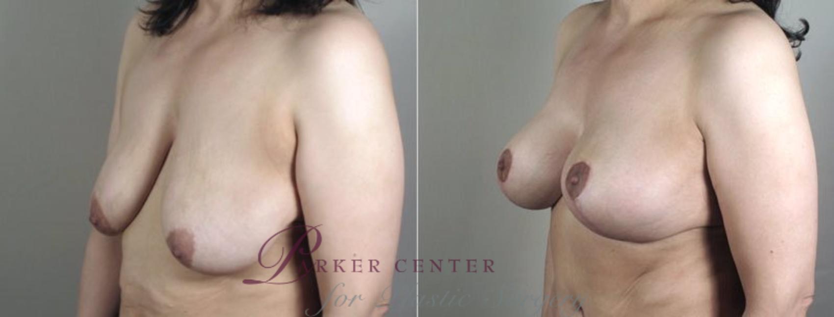 Mommy Makeover Case 472 Before & After View #2 | Paramus, NJ | Parker Center for Plastic Surgery