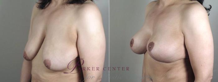 Breast Lift with Implants Case 472 Before & After View #2 | Paramus, NJ | Parker Center for Plastic Surgery