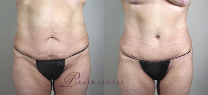 Breast Lift with Implants Case 472 Before & After View #3 | Paramus, NJ | Parker Center for Plastic Surgery