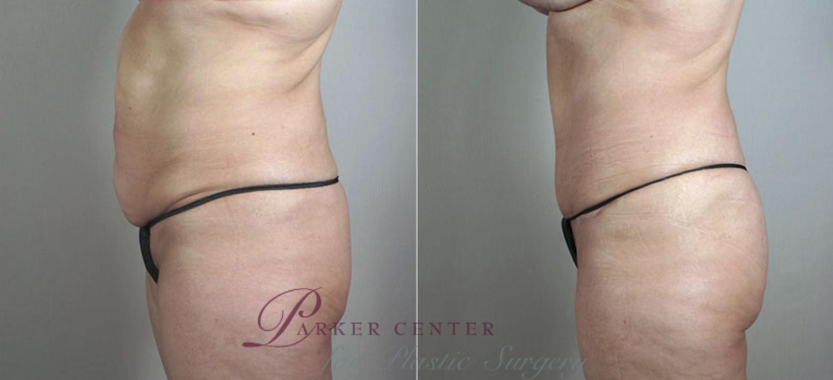 Mommy Makeover Case 472 Before & After View #4 | Paramus, NJ | Parker Center for Plastic Surgery