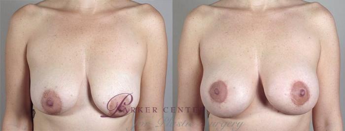 Breast Lift with Implants Case 473 Before & After View #1 | Paramus, NJ | Parker Center for Plastic Surgery