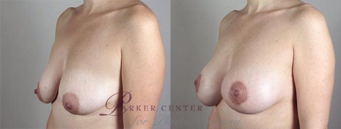 Breast Lift with Implants Case 473 Before & After View #2 | Paramus, NJ | Parker Center for Plastic Surgery