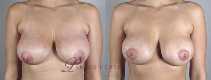 Breast Lift with Implants Case 474 Before & After View #1 | Paramus, NJ | Parker Center for Plastic Surgery