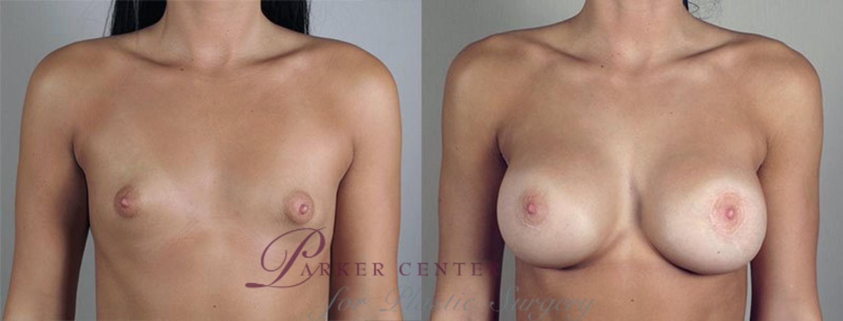 Correction of Tubular Breasts Case 475 Before & After View #1 | Paramus, NJ | Parker Center for Plastic Surgery