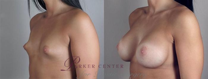 Breast Lift with Implants Case 475 Before & After View #2 | Paramus, NJ | Parker Center for Plastic Surgery