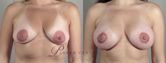 Breast Lift with Implants Case 476 Before & After View #1 | Paramus, NJ | Parker Center for Plastic Surgery