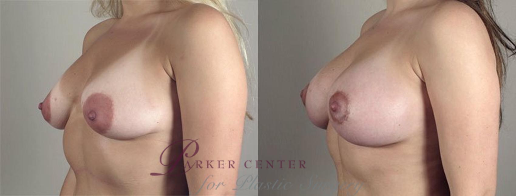 Breast Lift with Implants Case 476 Before & After View #2 | Paramus, NJ | Parker Center for Plastic Surgery