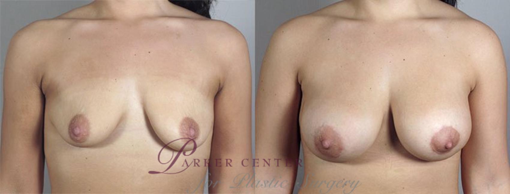 Breast Lift with Implants Case 477 Before & After View #1 | Paramus, NJ | Parker Center for Plastic Surgery
