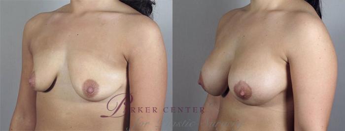 Breast Lift with Implants Case 477 Before & After View #2 | Paramus, NJ | Parker Center for Plastic Surgery
