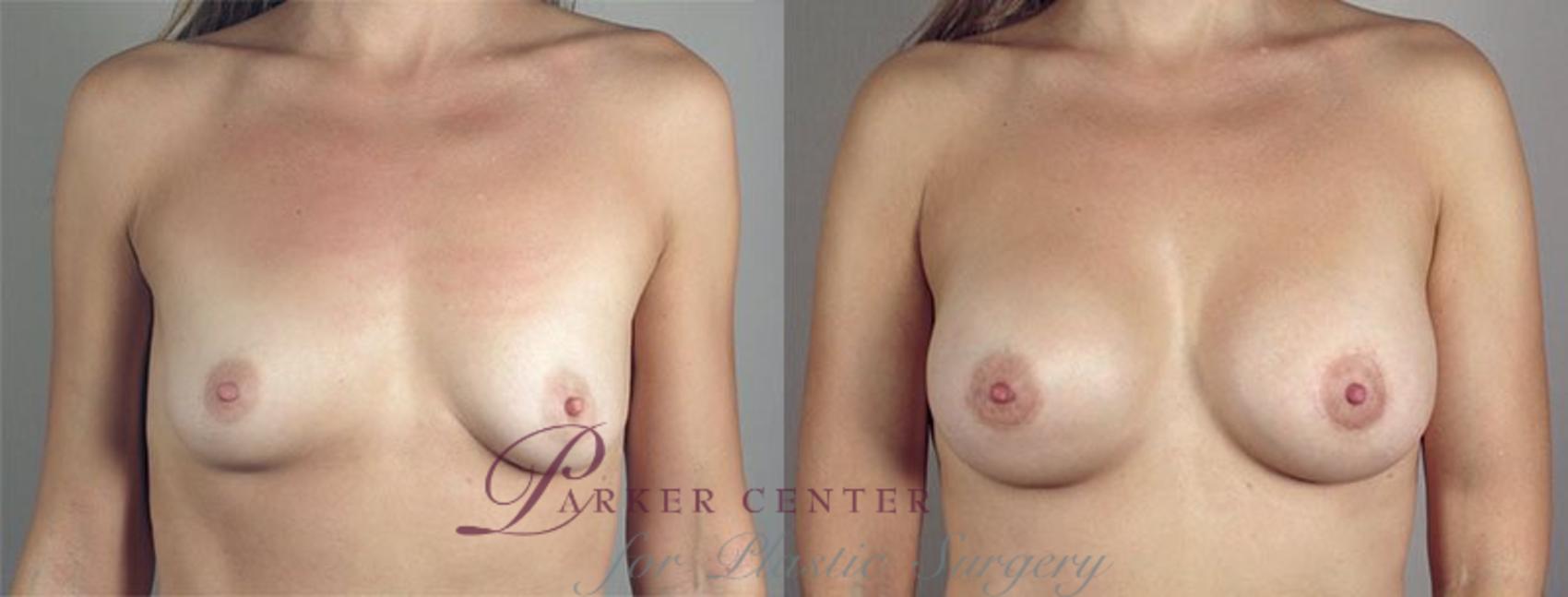 Breast Lift with Implants Case 478 Before & After View #1 | Paramus, NJ | Parker Center for Plastic Surgery
