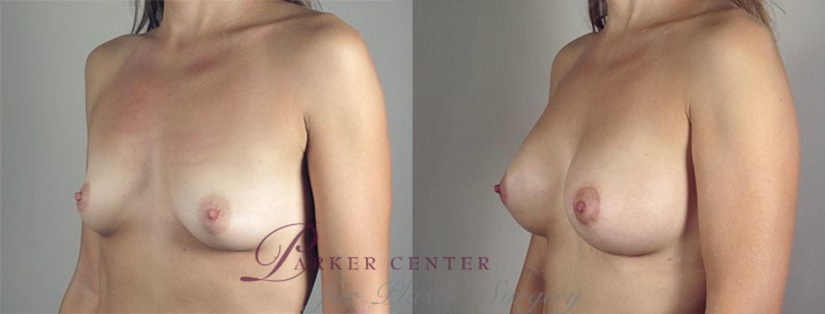 Breast Lift with Implants Case 478 Before & After View #2 | Paramus, NJ | Parker Center for Plastic Surgery