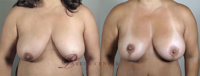 Breast Lift with Implants Case 479 Before & After View #1 | Paramus, NJ | Parker Center for Plastic Surgery
