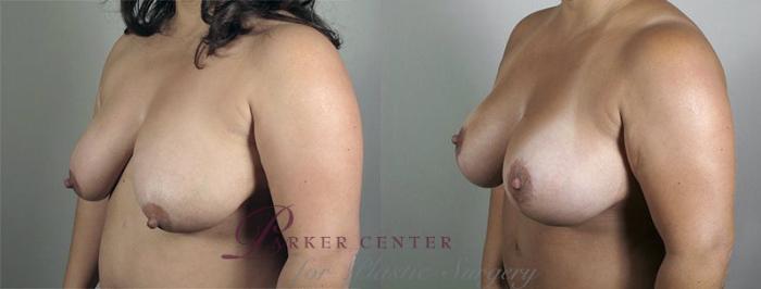 Breast Lift with Implants Case 479 Before & After View #2 | Paramus, NJ | Parker Center for Plastic Surgery