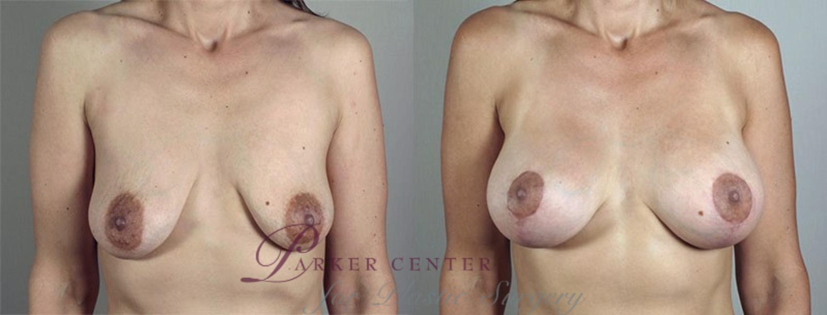 Breast Lift with Implants Case 480 Before & After View #1 | Paramus, NJ | Parker Center for Plastic Surgery