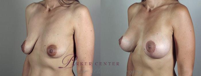 Breast Lift with Implants Case 480 Before & After View #2 | Paramus, NJ | Parker Center for Plastic Surgery
