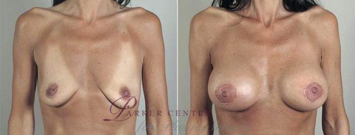 Breast Lift with Implants Case 481 Before & After View #1 | Paramus, NJ | Parker Center for Plastic Surgery