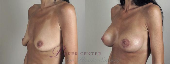 Breast Lift with Implants Case 481 Before & After View #2 | Paramus, NJ | Parker Center for Plastic Surgery