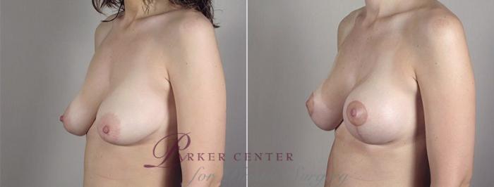 Breast Lift with Implants Case 482 Before & After View #1 | Paramus, NJ | Parker Center for Plastic Surgery