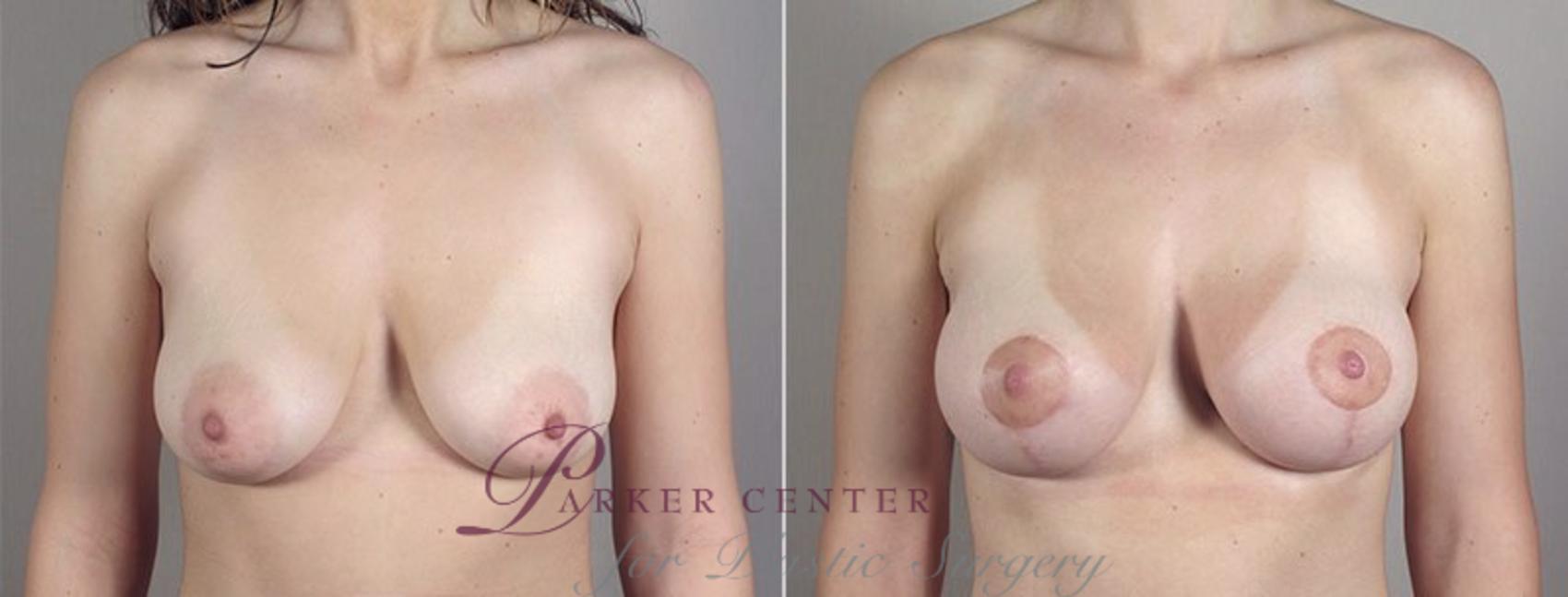 Breast Lift with Implants Case 482 Before & After View #2 | Paramus, NJ | Parker Center for Plastic Surgery