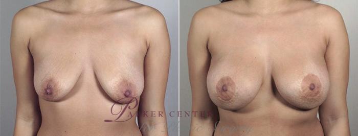 Breast Lift with Implants Case 483 Before & After View #1 | Paramus, NJ | Parker Center for Plastic Surgery