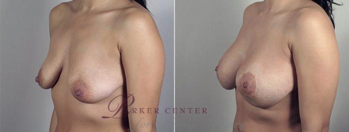 Breast Lift with Implants Case 483 Before & After View #2 | Paramus, NJ | Parker Center for Plastic Surgery