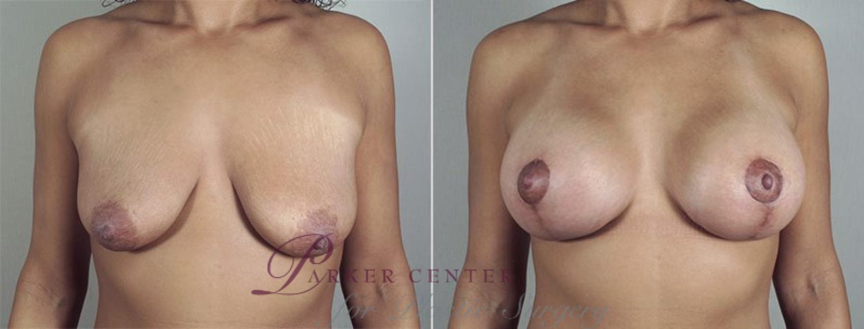 Breast Lift with Implants Case 484 Before & After View #1 | Paramus, NJ | Parker Center for Plastic Surgery