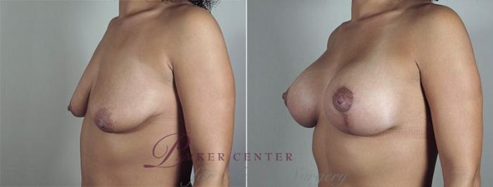 Breast Lift with Implants Case 484 Before & After View #2 | Paramus, NJ | Parker Center for Plastic Surgery