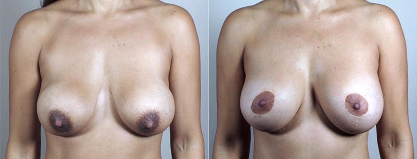 Breast Implant Revision Case 485 Before & After View #1 | Paramus, NJ | Parker Center for Plastic Surgery