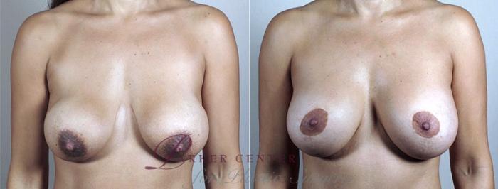 Breast Implant Revision Case 485 Before & After View #1 | Paramus, NJ | Parker Center for Plastic Surgery