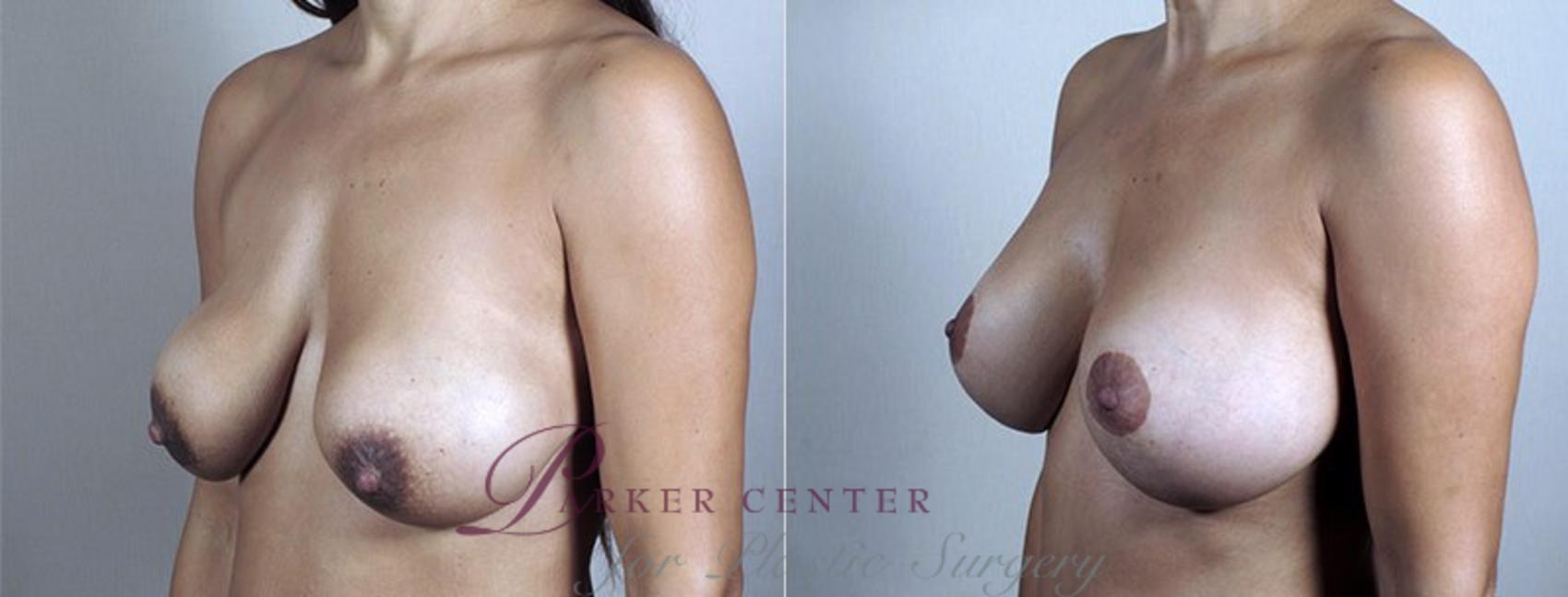 Mommy Makeover Case 485 Before & After View #2 | Paramus, NJ | Parker Center for Plastic Surgery