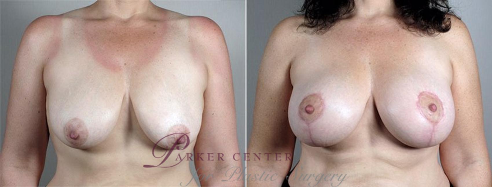 Breast Lift with Implants Case 486 Before & After View #1 | Paramus, NJ | Parker Center for Plastic Surgery