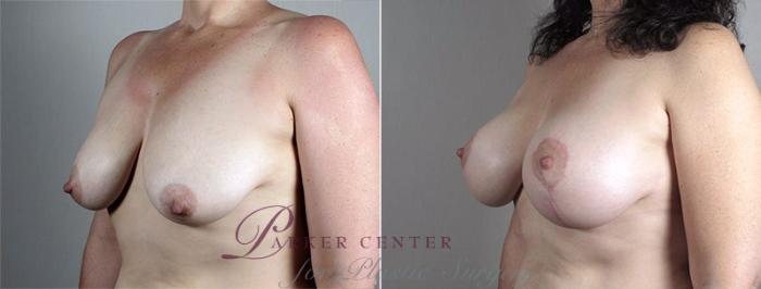 Breast Lift with Implants Case 486 Before & After View #2 | Paramus, NJ | Parker Center for Plastic Surgery