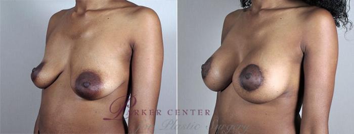 Breast Lift with Implants Case 487 Before & After View #2 | Paramus, NJ | Parker Center for Plastic Surgery