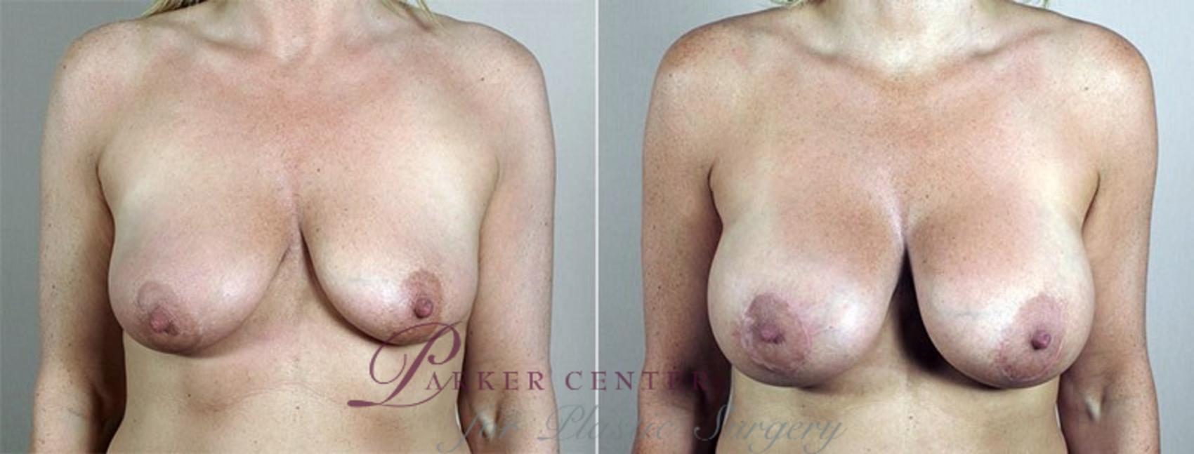 Breast Asymmetry Case 488 Before & After View #1 | Paramus, NJ | Parker Center for Plastic Surgery