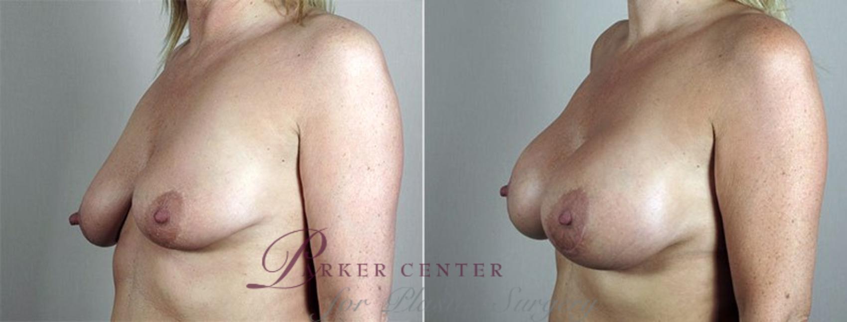 Breast Asymmetry Case 488 Before & After View #2 | Paramus, NJ | Parker Center for Plastic Surgery