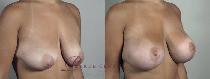 Breast Lift with Implants Case 491 Before & After View #2 | Paramus, NJ | Parker Center for Plastic Surgery