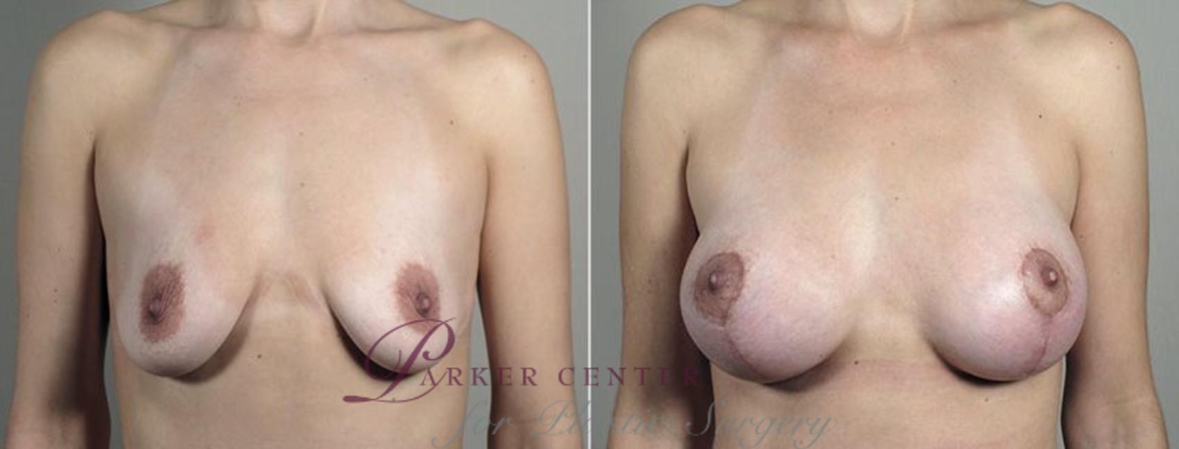 Breast Lift with Implants Case 492 Before & After View #1 | Paramus, NJ | Parker Center for Plastic Surgery