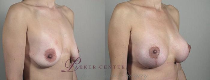 Breast Lift with Implants Case 492 Before & After View #2 | Paramus, NJ | Parker Center for Plastic Surgery