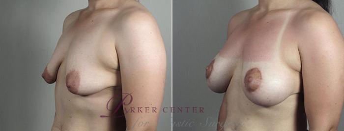 Breast Lift with Implants Case 493 Before & After View #2 | Paramus, NJ | Parker Center for Plastic Surgery