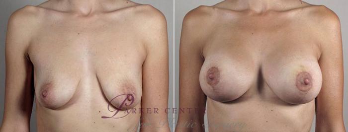 Breast Lift with Implants Case 494 Before & After View #1 | Paramus, NJ | Parker Center for Plastic Surgery